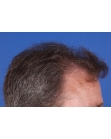 Before Hair Transplant&nbsp;Front